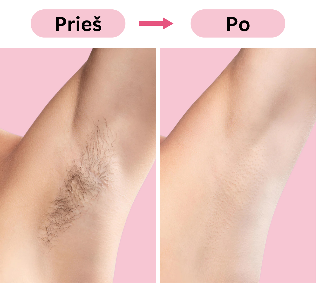 Prieš ir po IPL procedūros pažastų srityje – akivaizdus skirtumas po kelių naudojimų